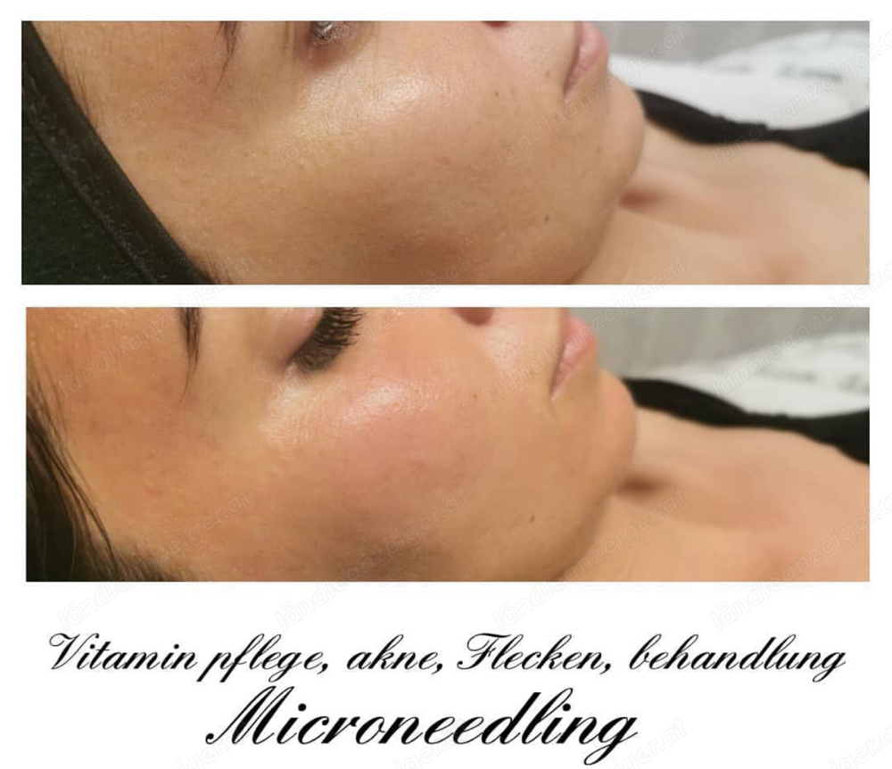 Kosmetik Microderma