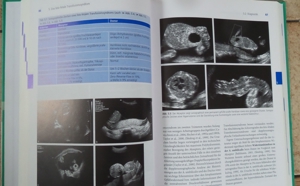 Mehrlingsschwangerschaften: Prä- und perinatales Management; Bild 4